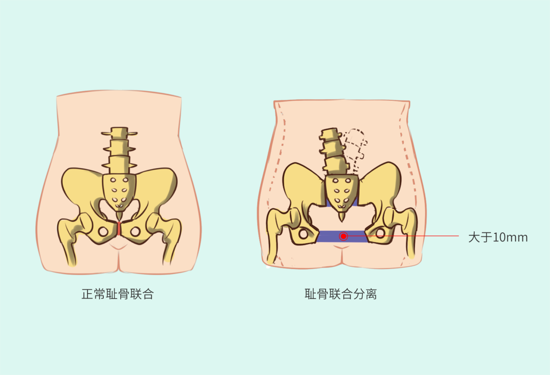 恥骨聯(lián)合2.png