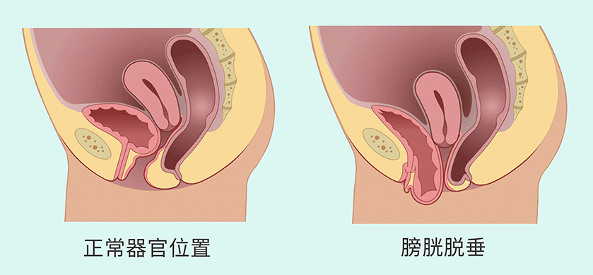 盆腔臟器脫垂2.png